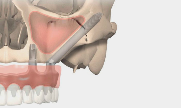 Les Implants Trans Zygomatiques, une technique d'implants dentaires sans greffe